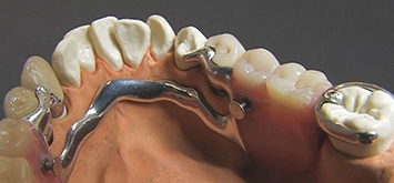 Kombinierte Zahnprothesen