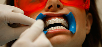 Profesjonell tannbleking