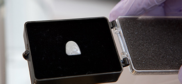 Facettes céramiques