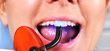 Plombage esthétique