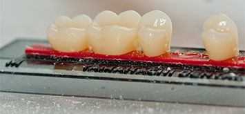 Remplacement de dent